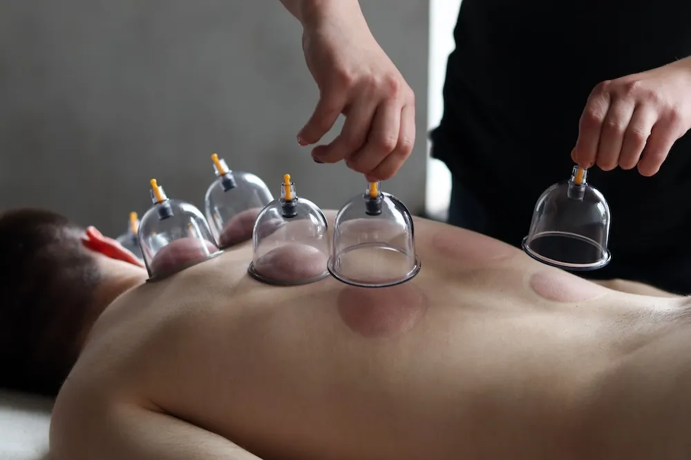 Cupping